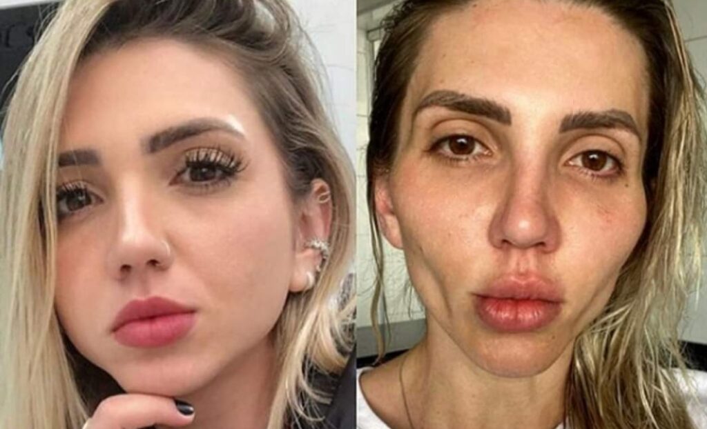 Influencer se deforma la cara con una cirugía estética